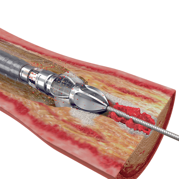 КАТЕТЕРЫ ДЛЯ ПРОВЕДЕНИЯ АРТЕРЭКТОМИИ JETSTREAM XC И SC image