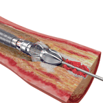 КАТЕТЕРЫ ДЛЯ ПРОВЕДЕНИЯ АРТЕРЭКТОМИИ JETSTREAM XC И SC image