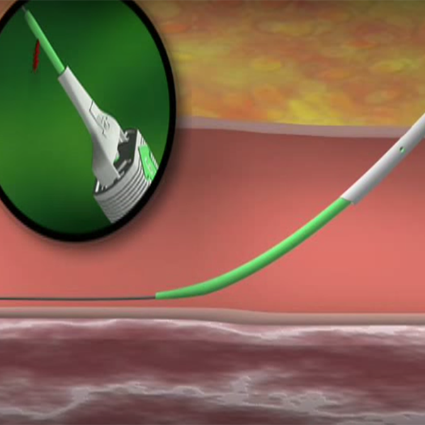 АНГИОСИЛ УСТРОЙСТВО ДЛЯ ЗАКРЫТИЯ ПУНКЦИИ (ANGIO-SEAL VIP) image