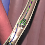 ЛОВУШКИ ДЛЯ ПРЕДОТВРАЩЕНИЯ МИГРАЦИИ КАМНЕЙ В МОЧЕТОЧНИКЕ STONE CONE image