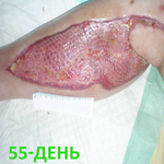 КЛИНИЧЕСКИЙ СЛУЧАЙ №3. ЗАЖИВЛЕНИЕ ВТОРИЧНЫМ НАТЯЖЕНИЕМ РАНА ПОСЛЕ АКШ image