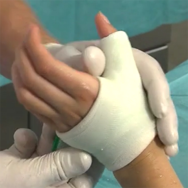 ПОВЯЗКА ИЗ ЦЕЛЛАКАСТА НА ЗАПЯСТЬЕ (ПЕРЕЛОМ ПЯСТНОЙ КОСТИ) image