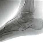 БАЛЛОННЫЙ КАТЕТЕР COYOTE НА СИСТЕМЕ ДОСТАВКИ ПО ПРОВОДНИКУ OTW (ПРОВОДНИК 0.014'') image