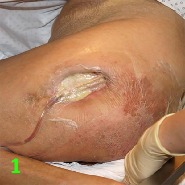 МЕТОДИКА НАЛОЖЕНИЯ ПОВЯЗКИ С ПРИМЕНЕНИЕМ СУПРАСОРБ CNP image