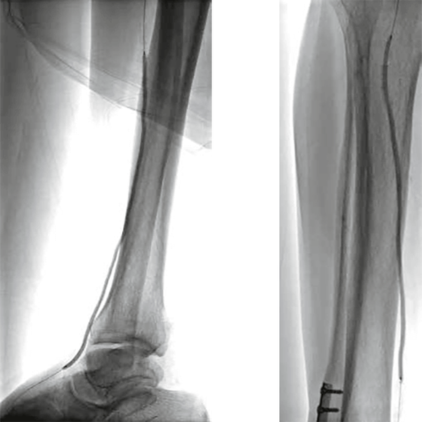 БАЛЛОННЫЙ КАТЕТЕР COYOTE НА СИСТЕМЕ ДОСТАВКИ ПО ПРОВОДНИКУ OTW (ПРОВОДНИК 0.014'') image