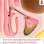 КАТЕТЕР ПРОВОДНИКОВЫЙ MESIRE image