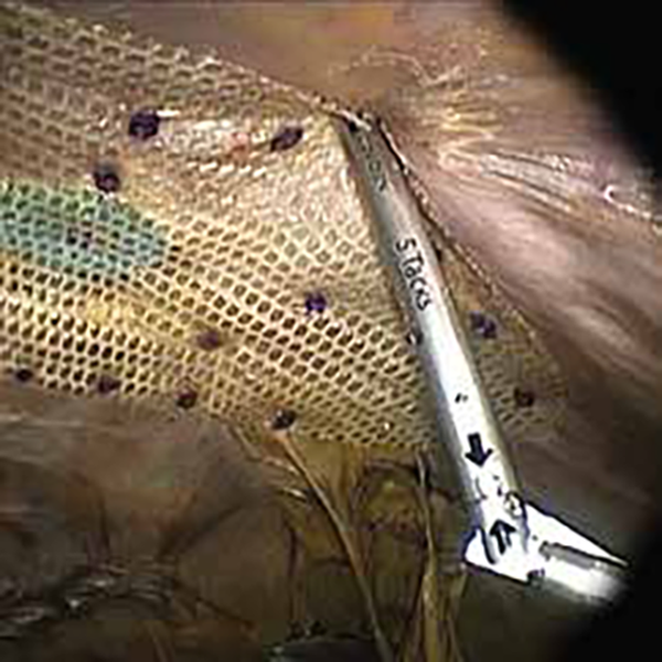 ГЕРНИОСТЕПЛЕР ЭНДОСКОПИЧЕСКИЙ ИЗГИБАЕМЫЙ С РАССАСЫВАЮЩИМИСЯ СКРЕПКАМИ RELIATACK image