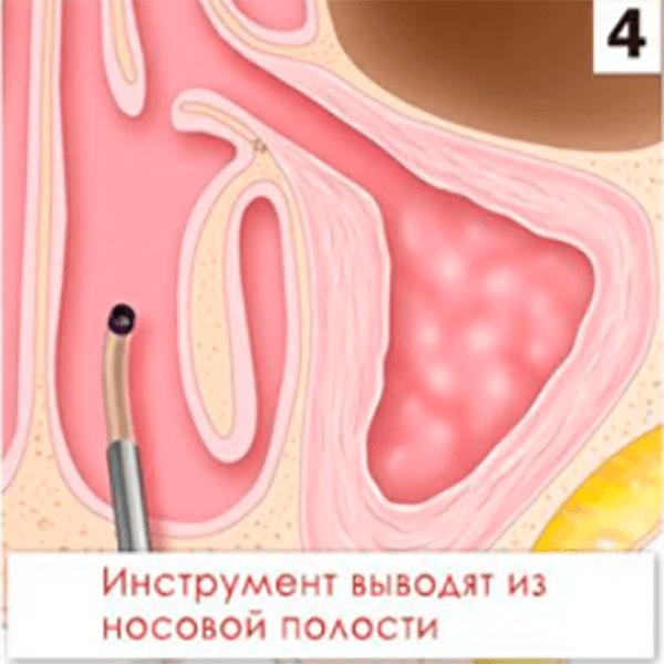 КАТЕТЕР ПРОВОДНИКОВЫЙ MESIRE image