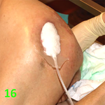 МЕТОДИКА НАЛОЖЕНИЯ ПОВЯЗКИ С ПРИМЕНЕНИЕМ СУПРАСОРБ CNP image