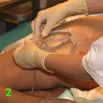 МЕТОДИКА НАЛОЖЕНИЯ ПОВЯЗКИ С ПРИМЕНЕНИЕМ СУПРАСОРБ CNP image