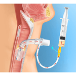 ТРАХЕОСТОМИЧЕСКАЯ ТРУБКА TRACHEOSOFT С КАНАЛОМ ДЛЯ САНАЦИИ НАДМАНЖЕТОЧНОГО ПРОСТРАНСТВА image