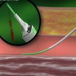АНГИОСИЛ УСТРОЙСТВО ДЛЯ ЗАКРЫТИЯ ПУНКЦИИ (ANGIO-SEAL VIP) image
