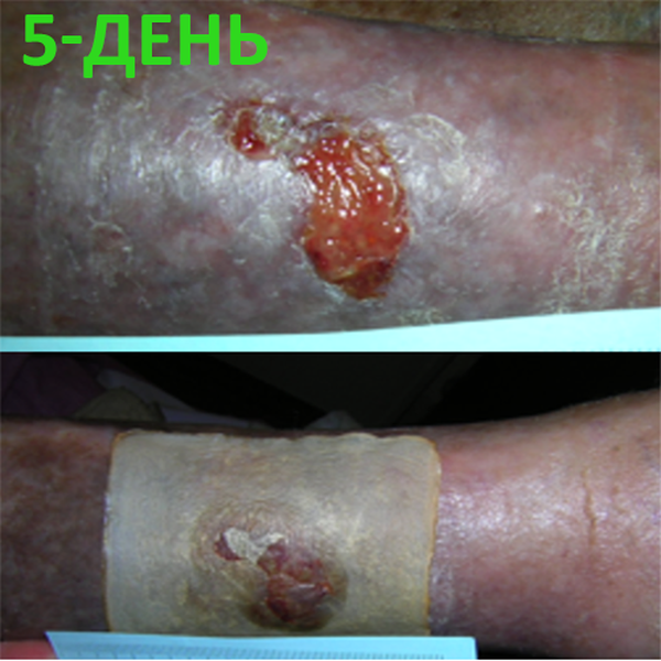 КЛИНИЧЕСКИЙ СЛУЧАЙ №4. ЯЗВА ГОЛЕНИ image