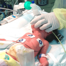 КОНТУРЫ ДЫХАТЕЛЬНЫЕ АНЕСТЕЗИОЛОГИЧЕСКИЕ (НАРКОЗНЫЕ) НЕОНАТАЛЬНЫЕ