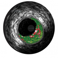ВОЗМОЖНОСТИ СИСТЕМЫ INTRASIGHT И VOLCANO (ВСУЗИ IFR/FFR)