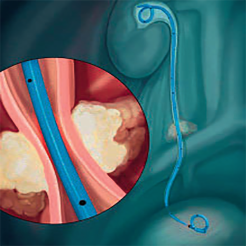 Операция мочевого канала