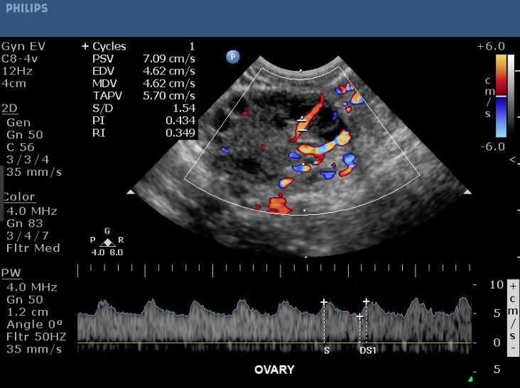 Изображение УЛЬТРАЗВУКОВОЙ АППАРАТ PHILIPS HD15