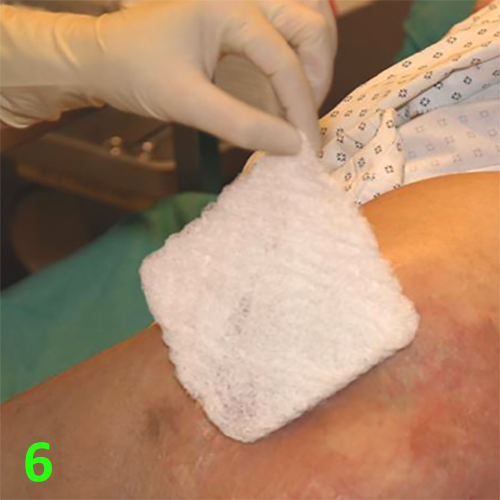 Изображение МЕТОДИКА НАЛОЖЕНИЯ ПОВЯЗКИ С ПРИМЕНЕНИЕМ СУПРАСОРБ CNP