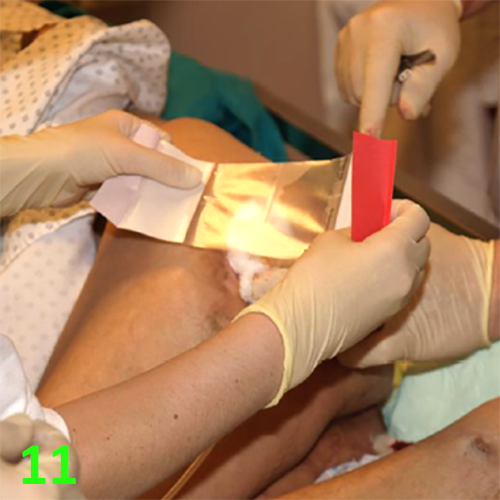 Изображение МЕТОДИКА НАЛОЖЕНИЯ ПОВЯЗКИ С ПРИМЕНЕНИЕМ СУПРАСОРБ CNP