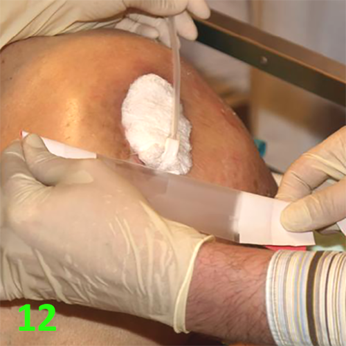 Изображение МЕТОДИКА НАЛОЖЕНИЯ ПОВЯЗКИ С ПРИМЕНЕНИЕМ СУПРАСОРБ CNP