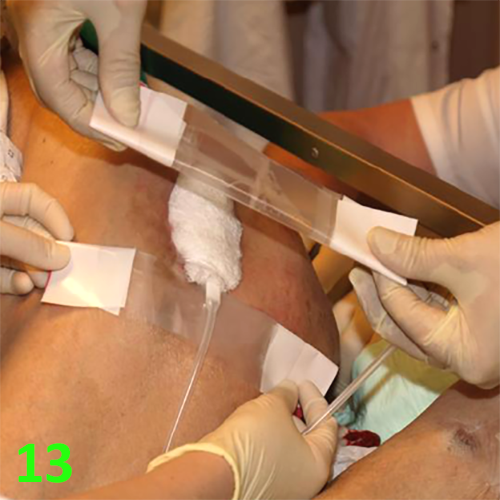 Изображение МЕТОДИКА НАЛОЖЕНИЯ ПОВЯЗКИ С ПРИМЕНЕНИЕМ СУПРАСОРБ CNP