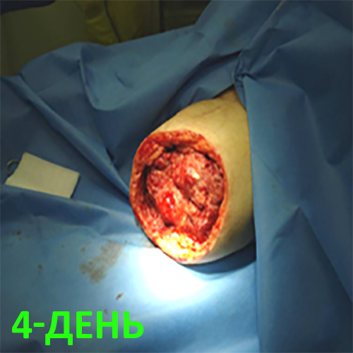 Изображение КЛИНИЧЕСКИЙ СЛУЧАЙ №1. ЭКЗАРТИКУЛЯЦИЯ С РЕВИЗИЕЙ КУЛЬТИ