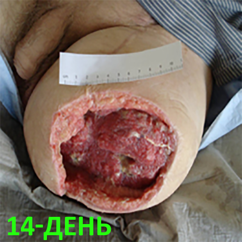 Изображение КЛИНИЧЕСКИЙ СЛУЧАЙ №1. ЭКЗАРТИКУЛЯЦИЯ С РЕВИЗИЕЙ КУЛЬТИ