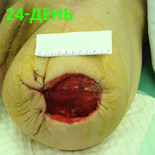 Изображение КЛИНИЧЕСКИЙ СЛУЧАЙ №1. ЭКЗАРТИКУЛЯЦИЯ С РЕВИЗИЕЙ КУЛЬТИ