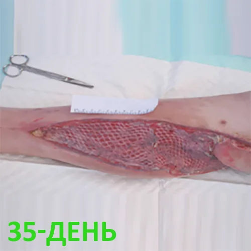 Изображение КЛИНИЧЕСКИЙ СЛУЧАЙ №3. ЗАЖИВЛЕНИЕ ВТОРИЧНЫМ НАТЯЖЕНИЕМ РАНА ПОСЛЕ АКШ
