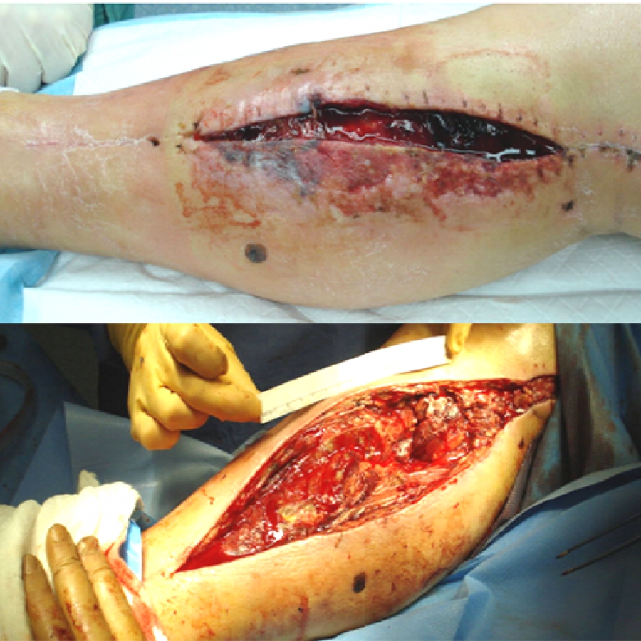 Изображение КЛИНИЧЕСКИЙ СЛУЧАЙ №3. ЗАЖИВЛЕНИЕ ВТОРИЧНЫМ НАТЯЖЕНИЕМ РАНА ПОСЛЕ АКШ