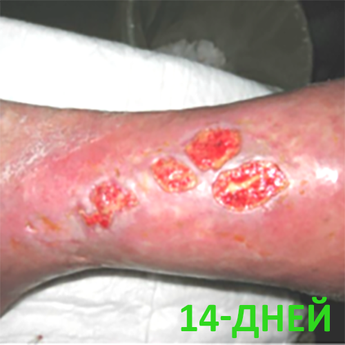 Изображение КЛИНИЧЕСКИЙ СЛУЧАЙ №2. ВЕНОЗНАЯ ЯЗВА