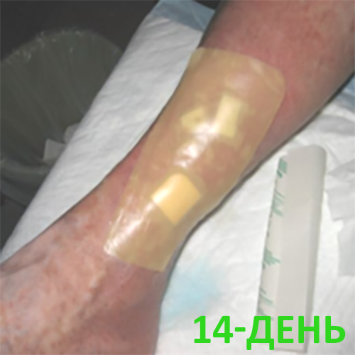 Изображение КЛИНИЧЕСКИЙ СЛУЧАЙ №2. ВЕНОЗНАЯ ЯЗВА