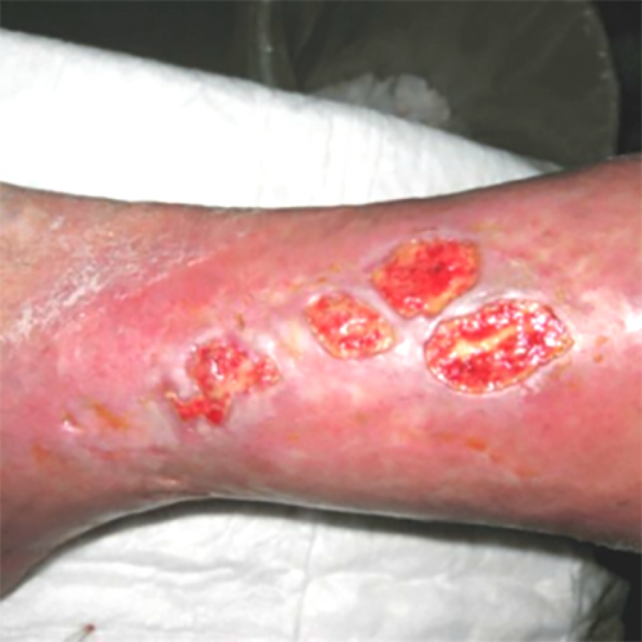 Изображение КЛИНИЧЕСКИЙ СЛУЧАЙ №2. ВЕНОЗНАЯ ЯЗВА