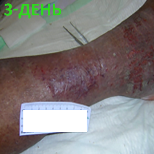 Изображение КЛИНИЧЕСКИЙ СЛУЧАЙ №3. ЯЗВА ГОЛЕНИ