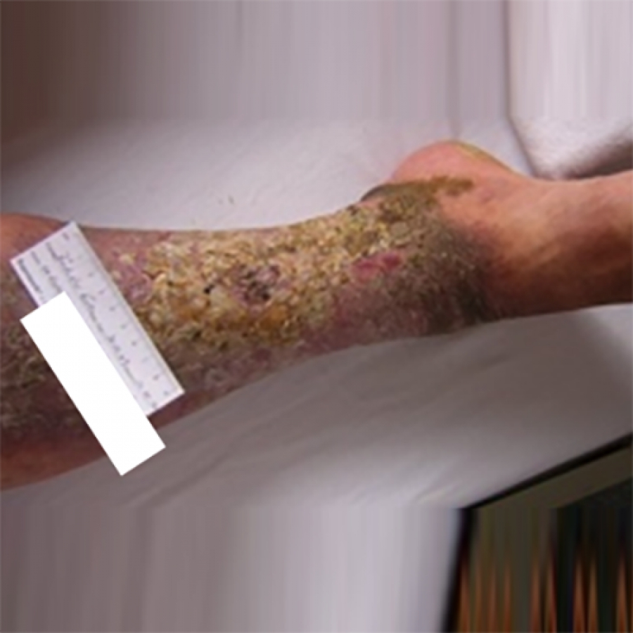 Изображение КЛИНИЧЕСКИЙ СЛУЧАЙ №3. ЯЗВА ГОЛЕНИ