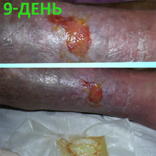 Изображение КЛИНИЧЕСКИЙ СЛУЧАЙ №4. ЯЗВА ГОЛЕНИ