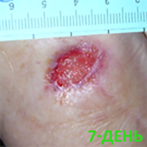 Изображение КЛИНИЧЕСКИЙ СЛУЧАЙ №5. ДИАБЕТИЧЕСКАЯ СТОПА