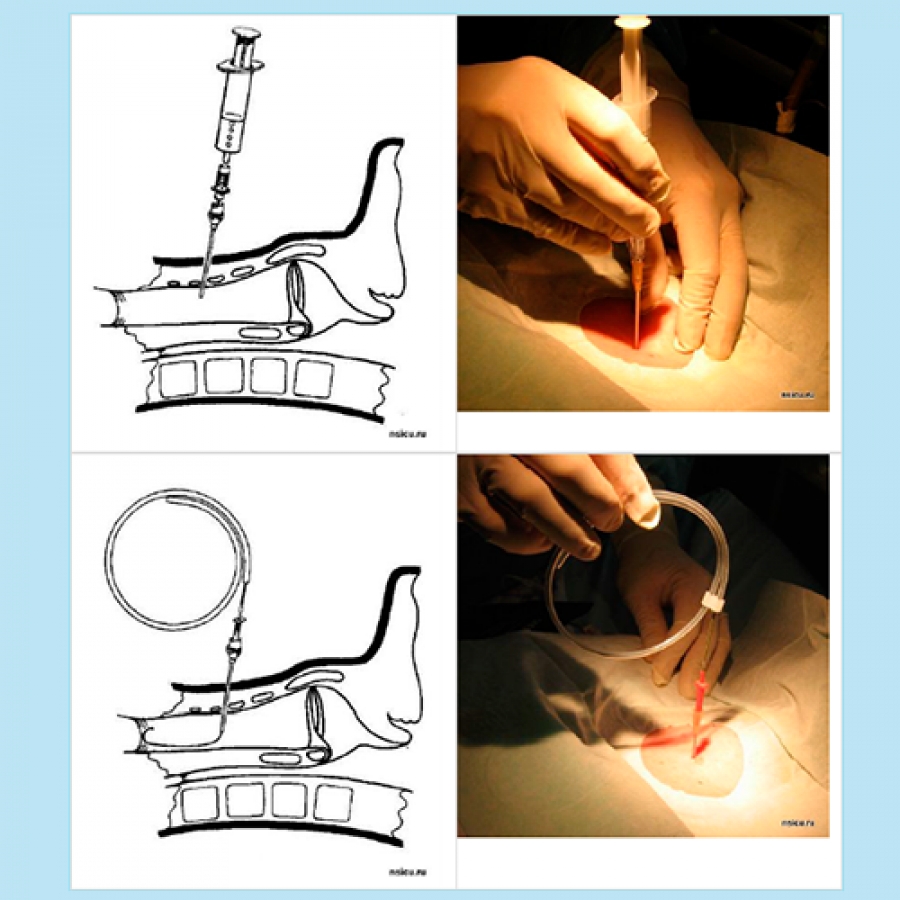 Изображение ДИЛЯТАЦИОННАЯ ТРАХЕОСТОМИЯ (РУКОВОДСТВО)