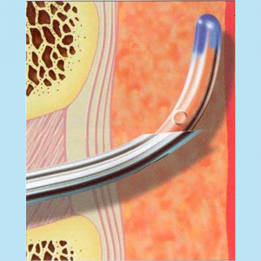 Изображение ЭПИДУРАЛЬНАЯ, СПИНАЛЬНАЯ И КОМБИНИРОВАННАЯ АНЕСТЕЗИЯ