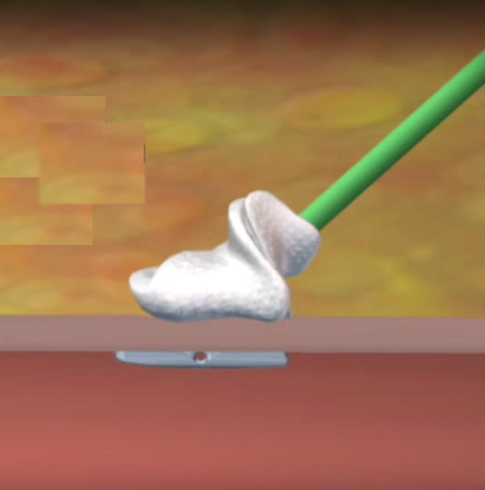 Изображение АНГИОСИЛ УСТРОЙСТВО ДЛЯ ЗАКРЫТИЯ ПУНКЦИИ (ANGIO-SEAL VIP)