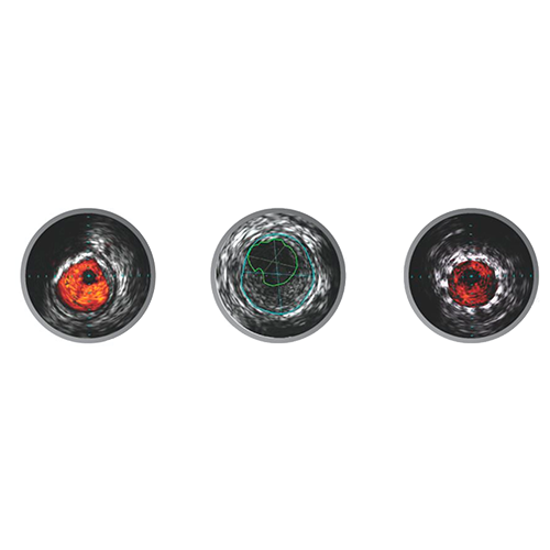 Изображение ЦИФРОВЫЕ КАТЕТЕРЫ ДЛЯ ПЕРИФЕРИЧЕСКИХ ВНУТРИСОСУДИСТЫХ УЛЬТРАЗВУКОВЫХ ИССЛЕДОВАНИЙ VISIONS