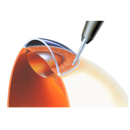 Изображение СКАЛЬПЕЛИ С ФИКСИРОВАННОЙ ГЛУБИНОЙ РАЗРЕЗА