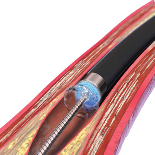 Изображение ЛАЗЕРНЫЙ КАТЕТЕР TURBO ELITE ДЛЯ ПЕРИФЕРИЧЕСКИХ АРТЕРИЙ