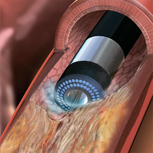 Изображение ЛАЗЕРНЫЙ КАТЕТЕР ELCA ДЛЯ КОРОНАРНЫХ АРТЕРИЙ