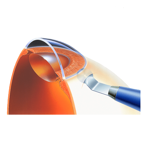 Изображение КРУГЛЫЙ СКАЛЬПЕЛЬ-РАССЛАИВАТЕЛЬ