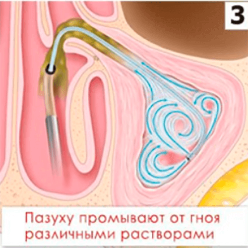 Изображение КАТЕТЕР ПРОВОДНИКОВЫЙ MESIRE