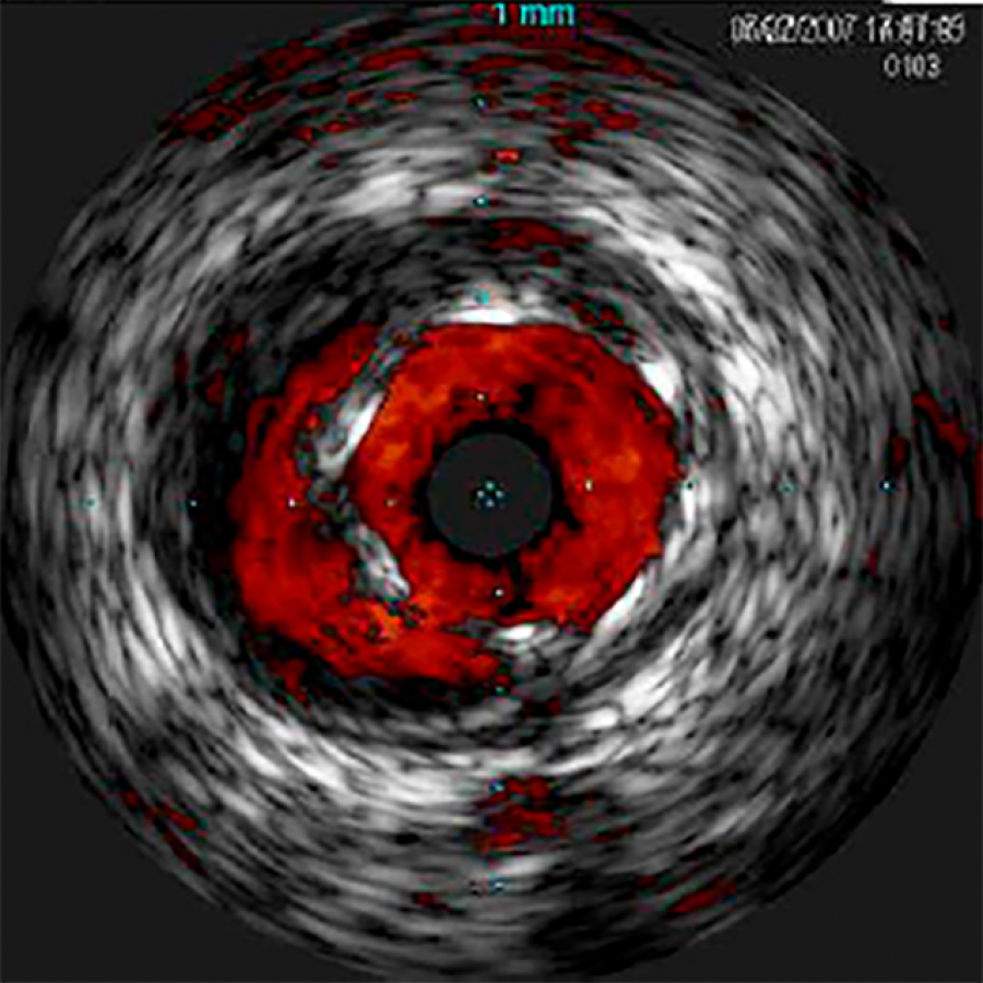Изображение VOLCANO РЕЖИМ ВИЗУАЛИЗАЦИИ КРОВОТОКА CHROMAFLO ВСУЗИ