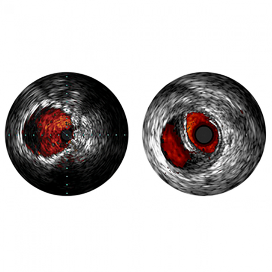 Изображение VOLCANO РЕЖИМ ВСУЗИ ЦИФРОВЫЕ КАТЕТЕРЫ EAGLE EYE ДЛЯ ПЕРИФЕРИЧЕСКИХ АРТЕРИЙ