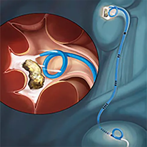 Изображение СТЕНТ МОЧЕТОЧНИКОВЫЙ УНИВЕРСАЛЬНОЙ ДЛИНЫ CONTOUR VL INJECTION