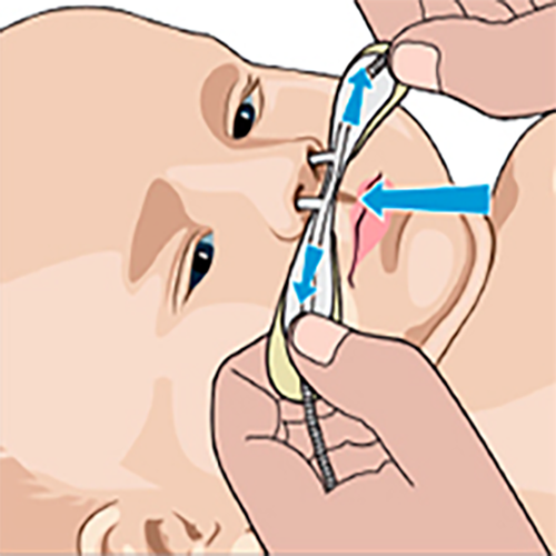 Изображение КАНЮЛИ OPTIFLOW ДЕТСКИЕ И НЕОНАТАЛЬНЫЕ